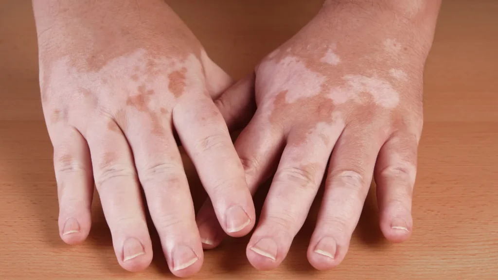 What Causes Autoimmune Disease? What the Research Actually Shows